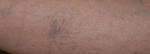Sclerotherapy - Case #1 Before